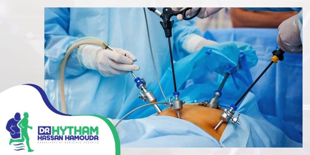 عملية التكميم بالتخدير الموضعي-اضرار عملية تكميم المعدة